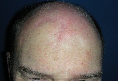 forehead cancer skin flap surgeon plastic treated repair local op case previous marucci damian reconstructive cosmetic dr