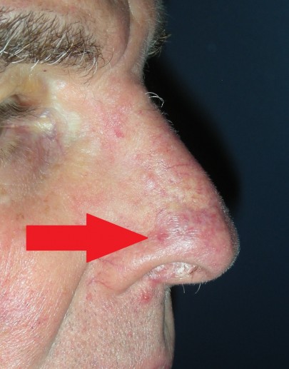 Gallery For Skin Cancer Nose