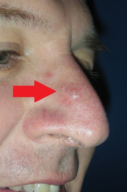 skin-cancer-signs-of-skin-cancer-on-nose