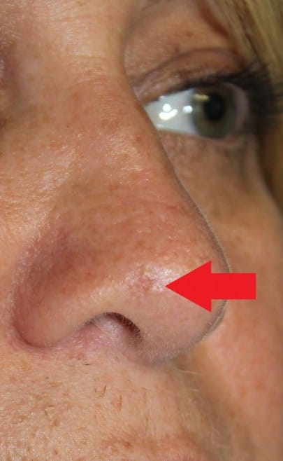 skin-cancer-nose-skin-cancer