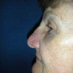 Image of flap reconstruction of nose