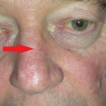 Image of skin cancer left nose