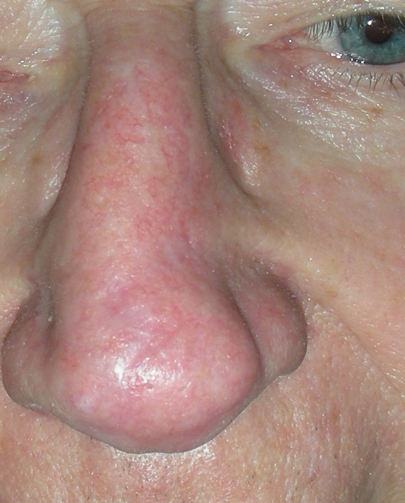 Image of Nose after reconstructive surgery