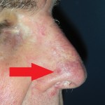 Skin cancer nose