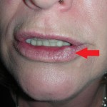 Skin cancer lower lip