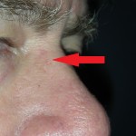 Skin cancer nose