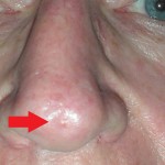 Image of skin cancer tip of nose