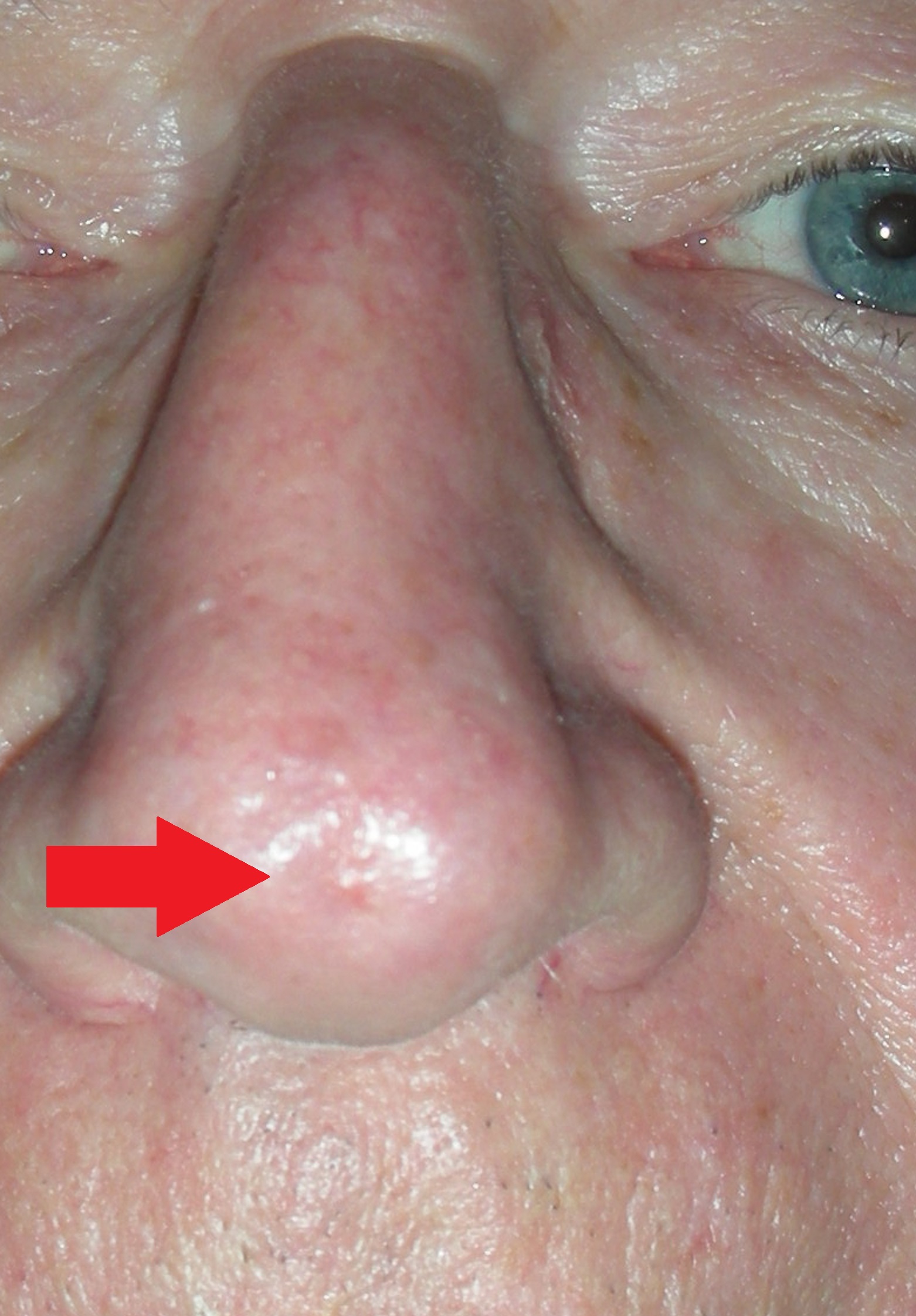 Skin Cancer Nose with Local Flap Repair - A/Prof Damian Marucci cosmetic  plastic reconstructive surgeon