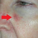 Image of skin cancer left nose