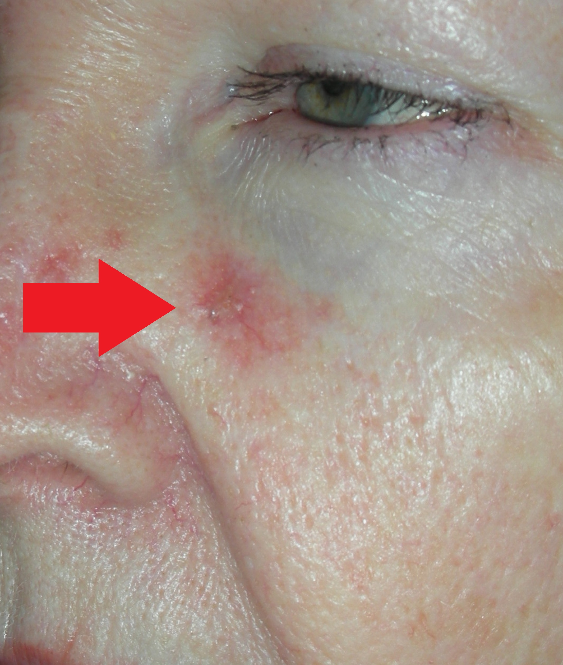 Skin cancer Nose and Local Flap Repair - A/Prof Damian Marucci