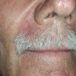 Post op image of upper lip local flap