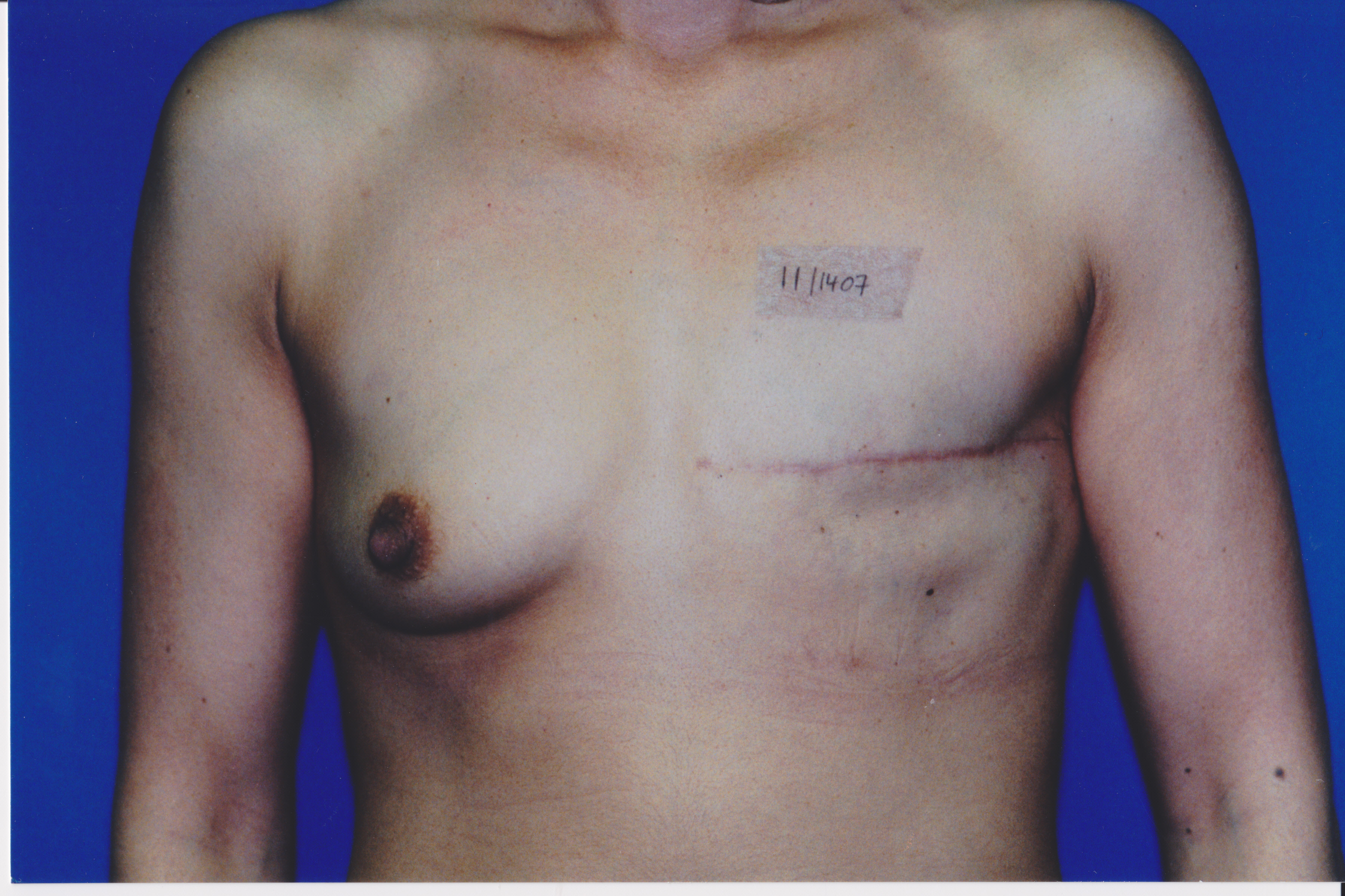 Pre op breast reconstruction