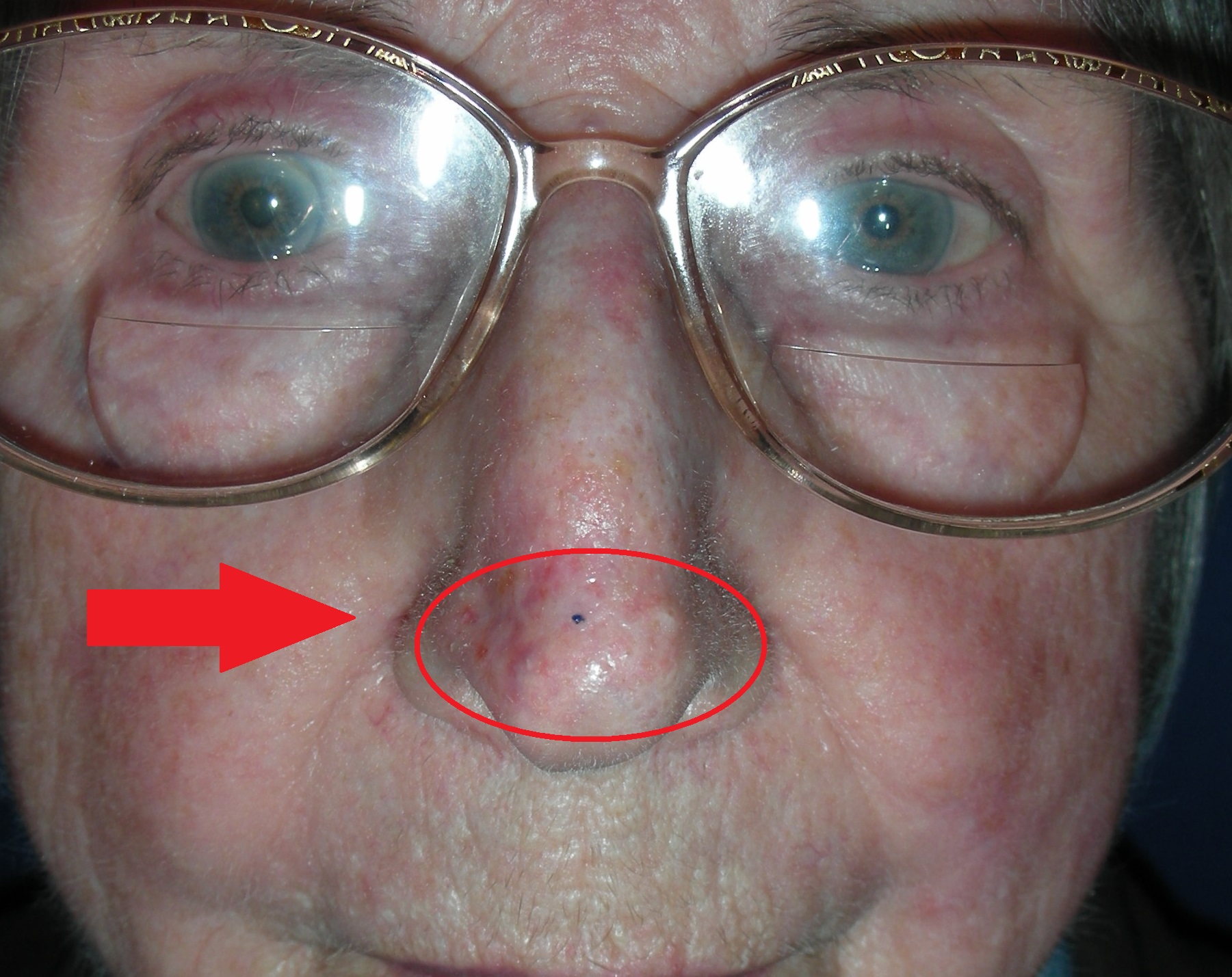 Skin Cancer Nose with skin graft - A/Prof Damian Marucci cosmetic