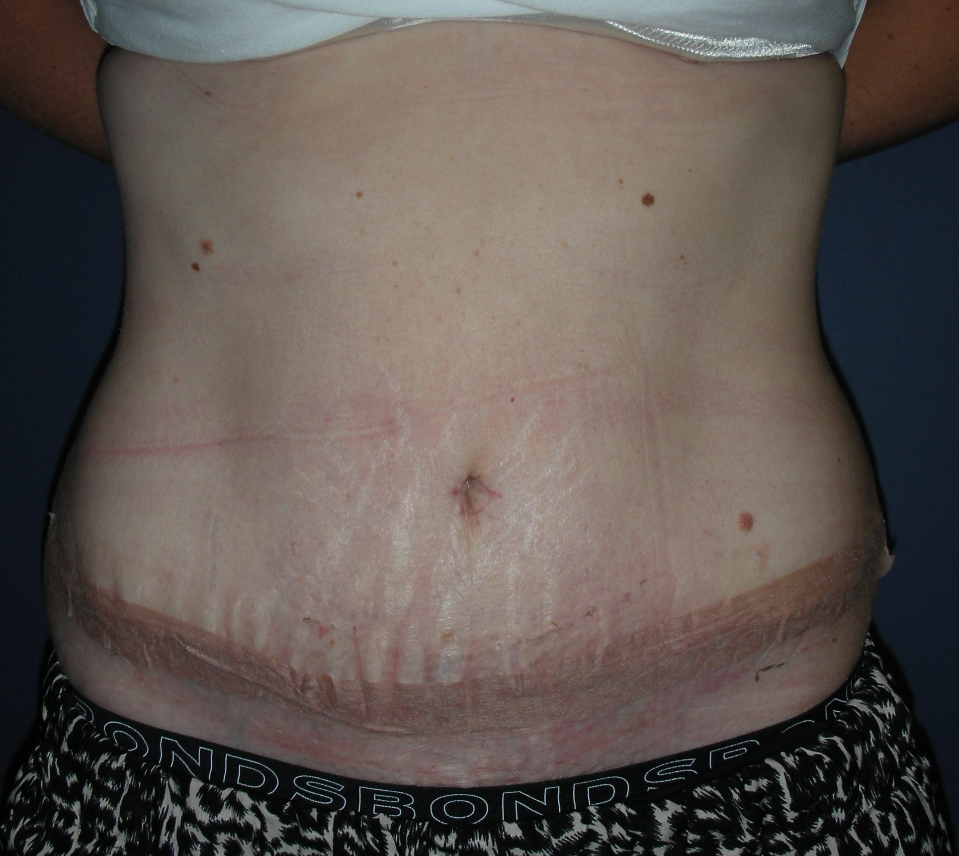 Post abdominoplasty