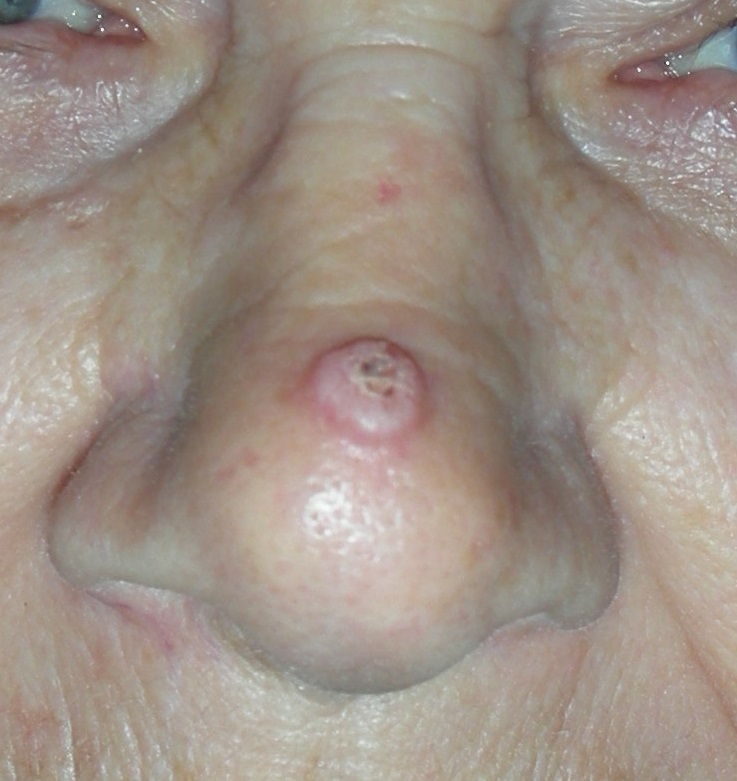 Skin cancer nose