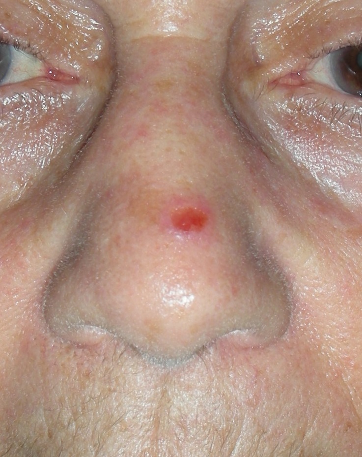 Skin cancer nose