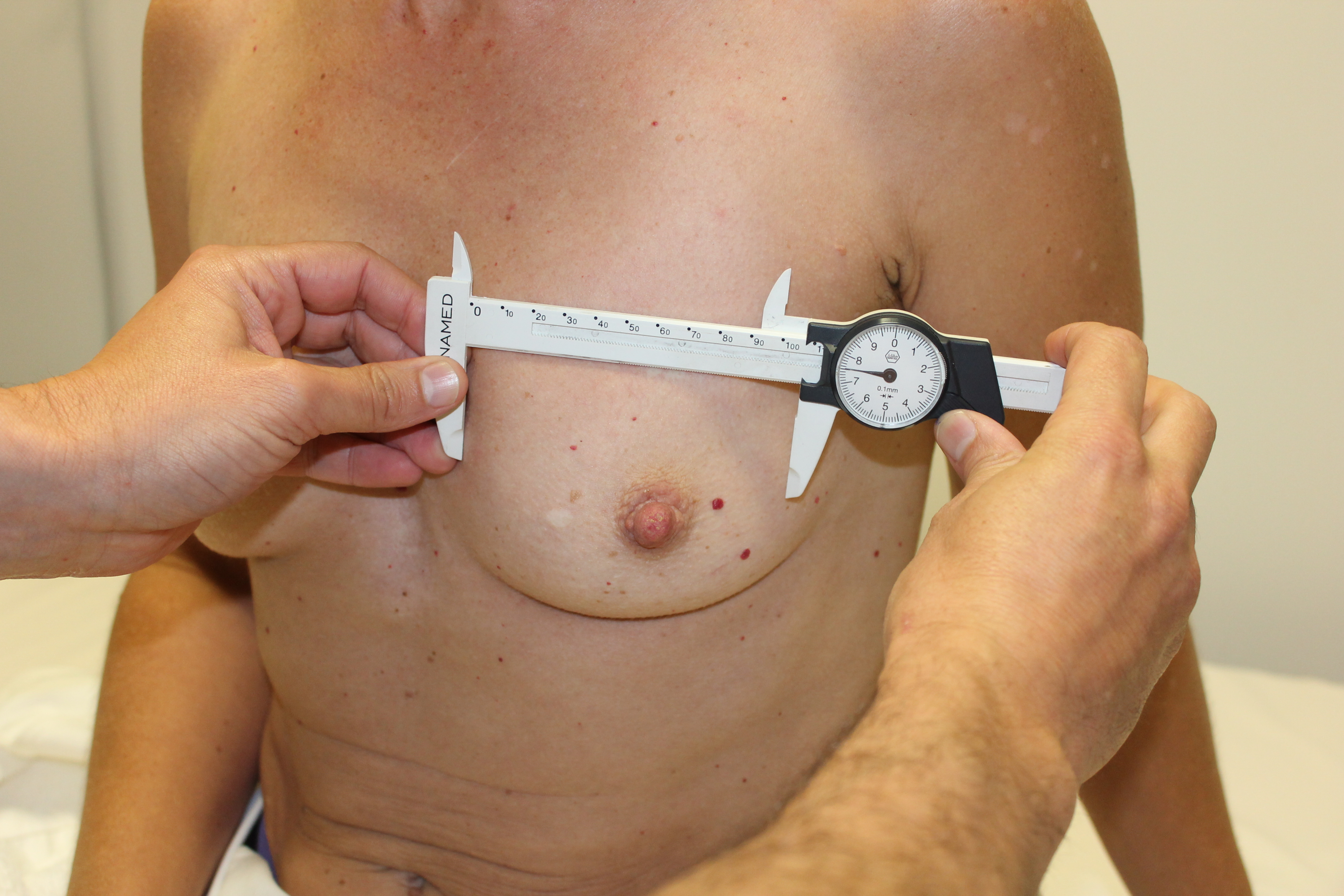 Measuring the breast base width while pinching the skin to