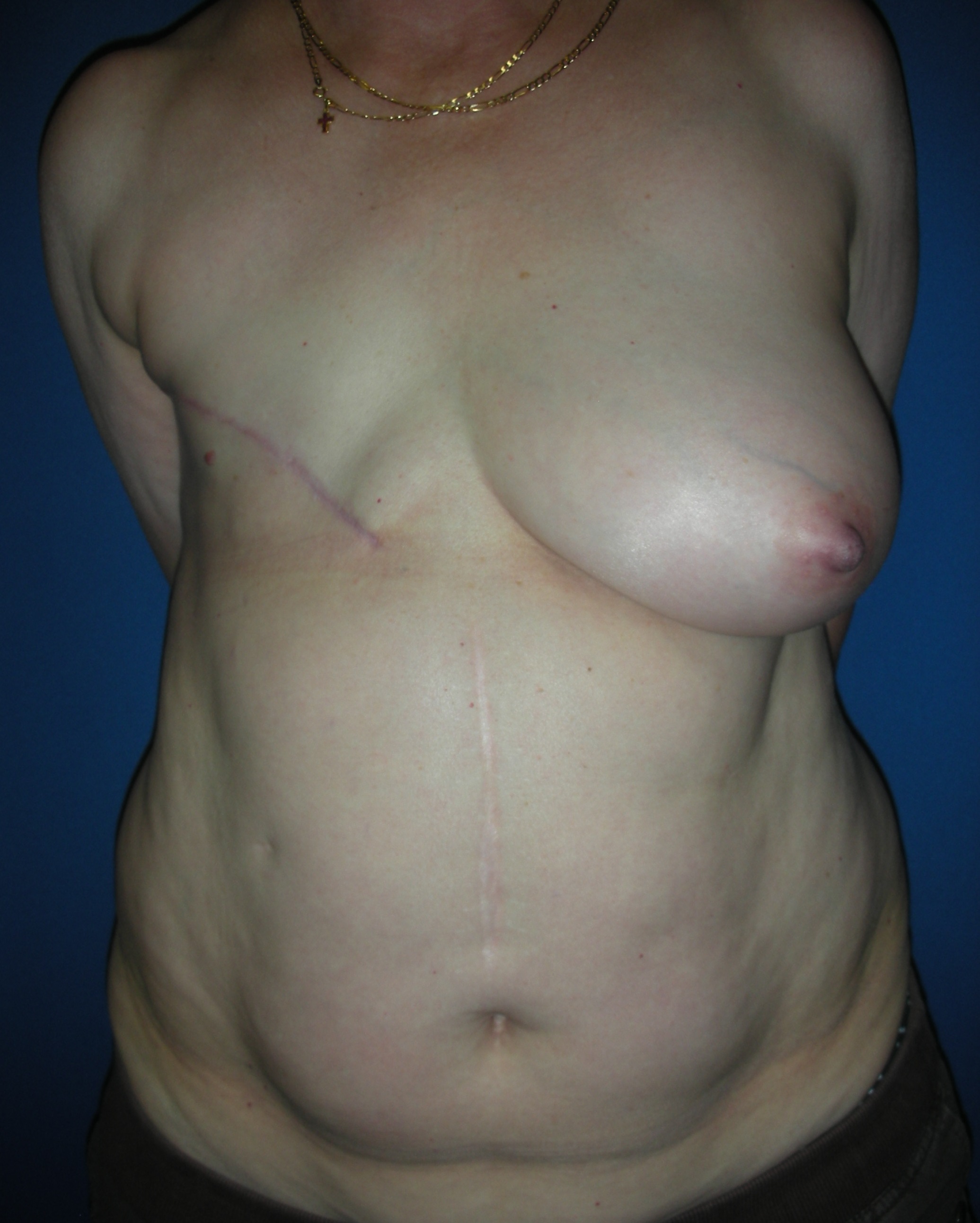 форум женщин с кистой груди фото 115