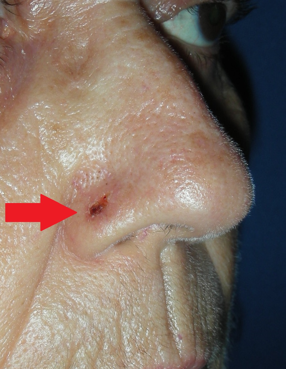 Skin cancer nose