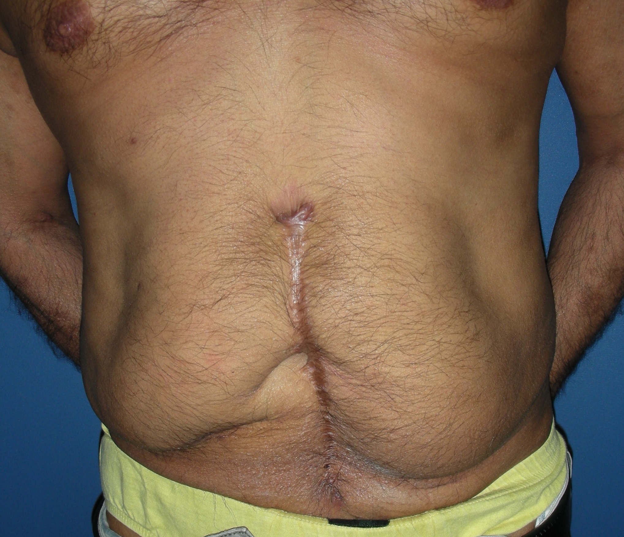 Pre op tummy tuck