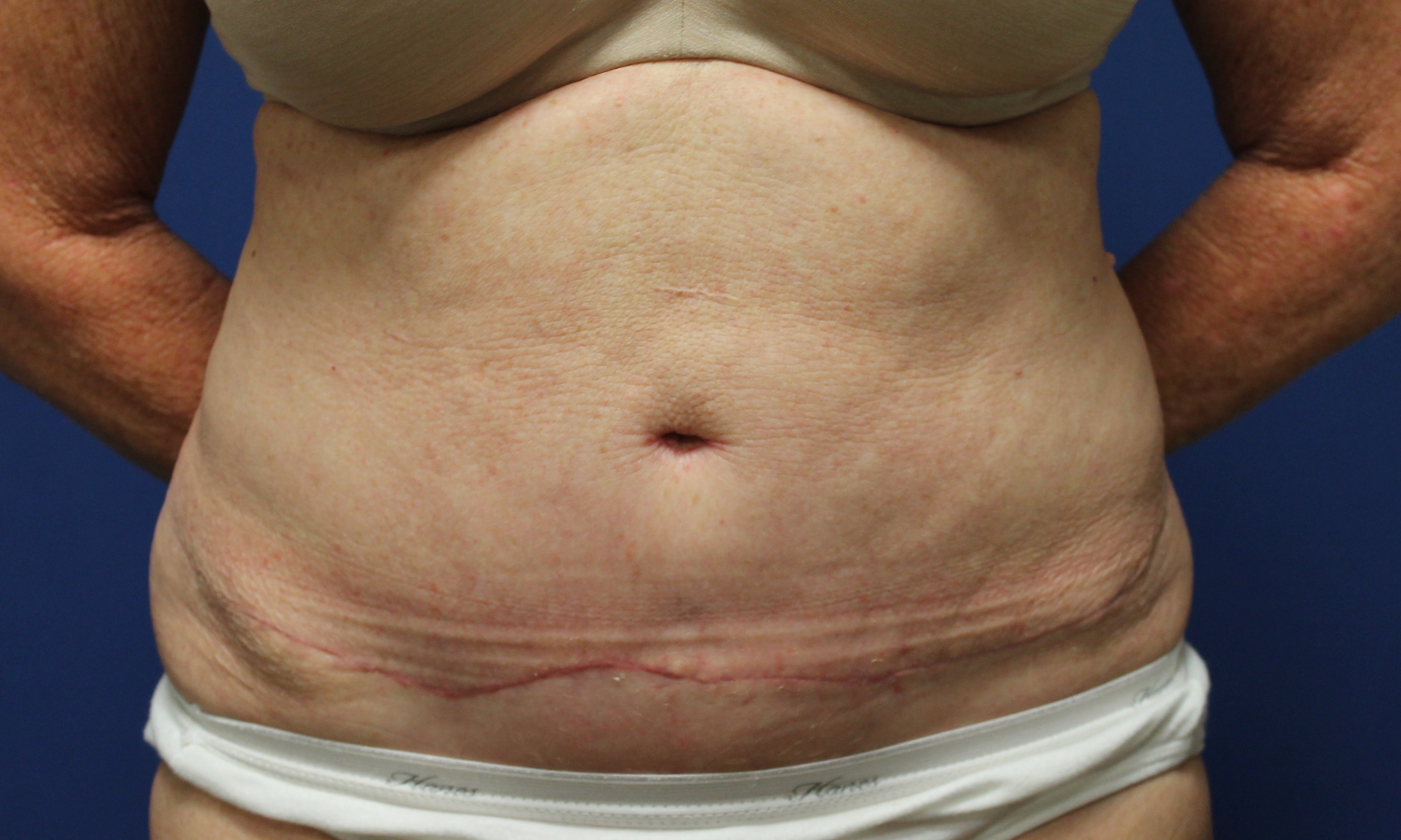 Post op tummy tuck