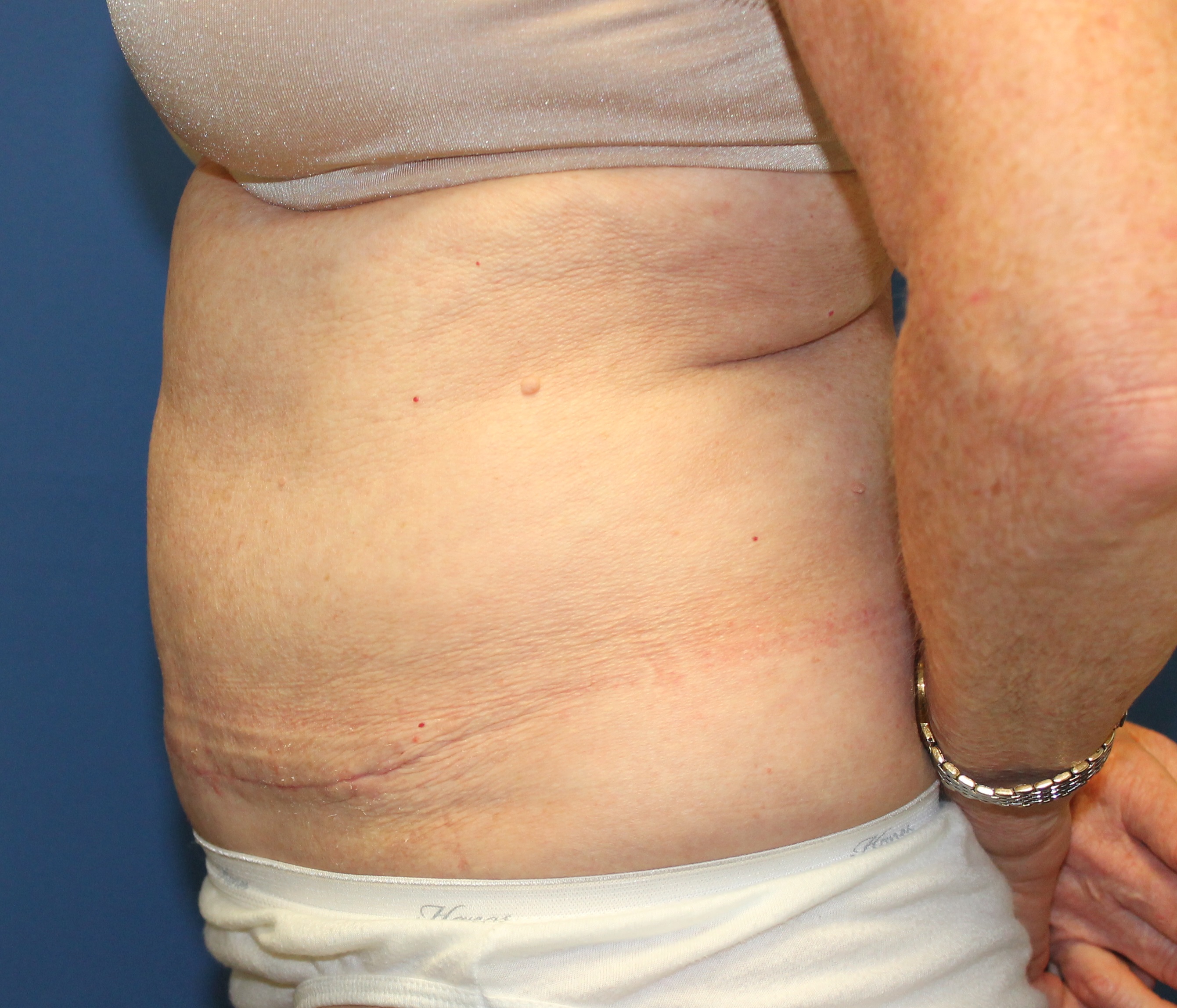 Post op tummy tuck