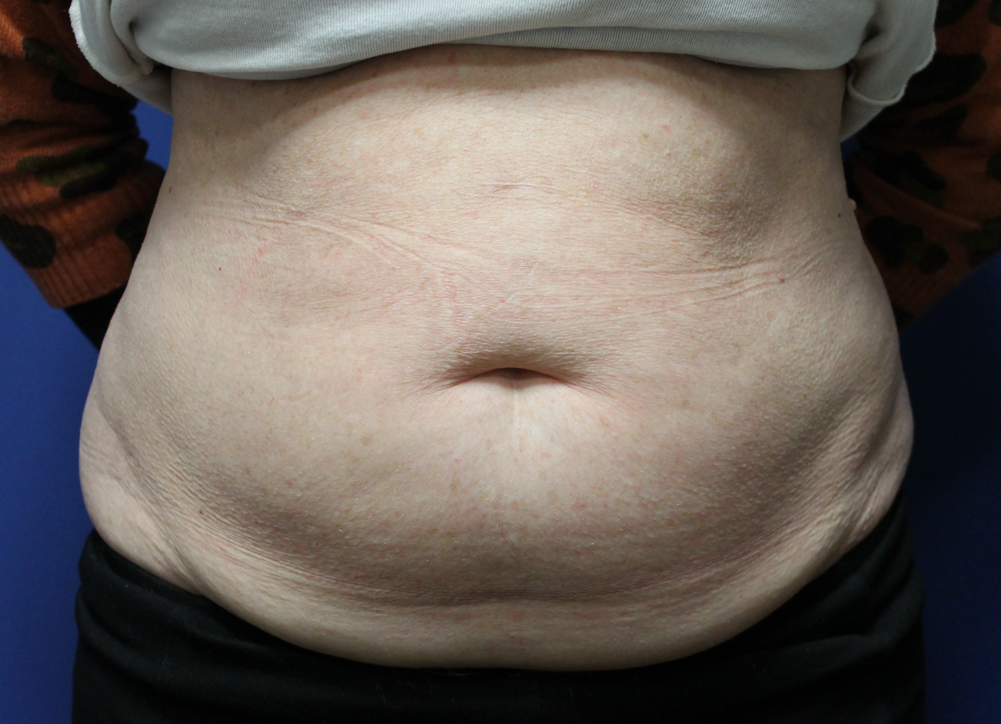 Pre op abdominoplasty