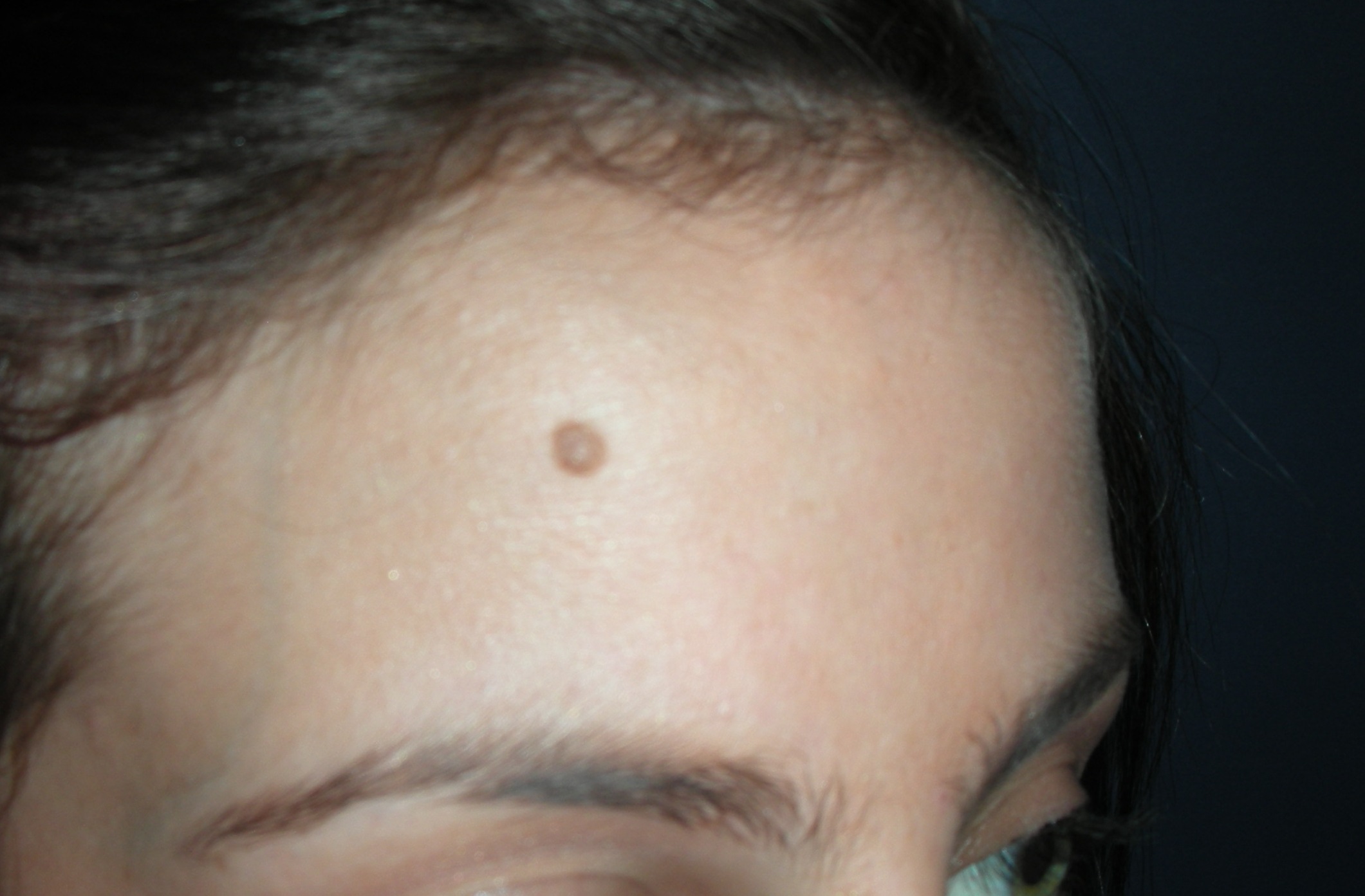 Forehead mole