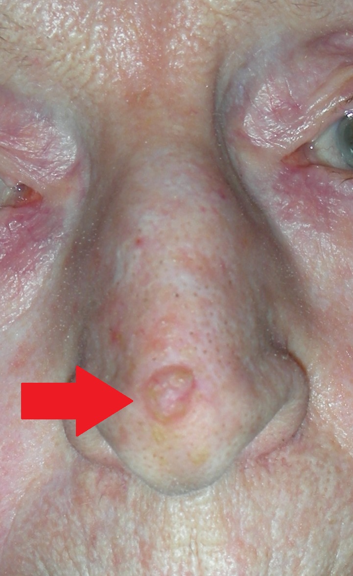 Skin cancer nose