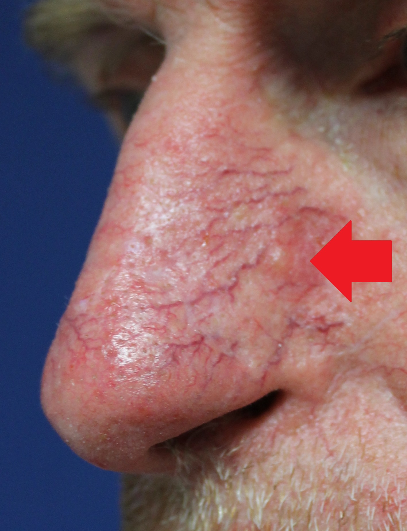 Skin cancer nose