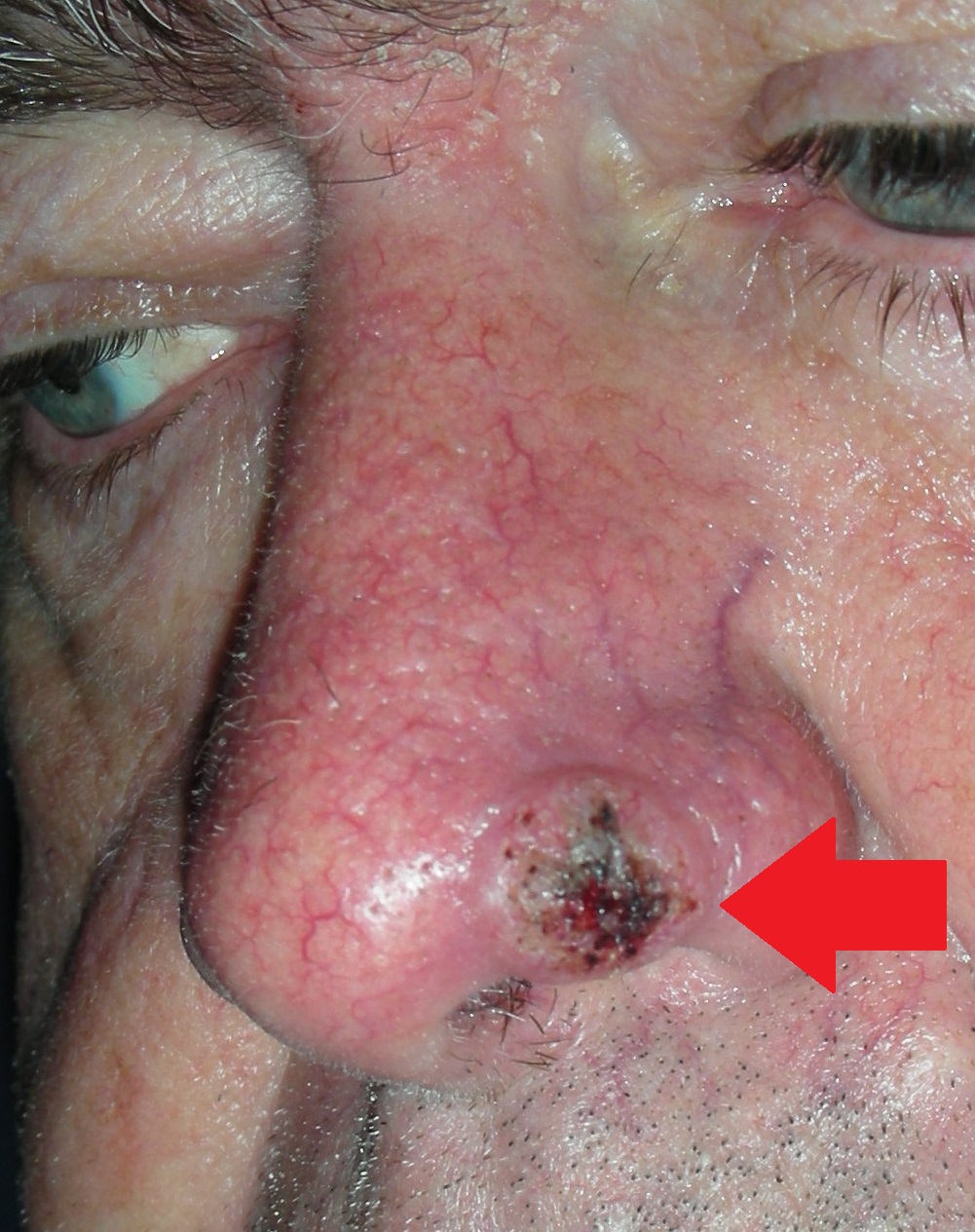 Skin cancer nose