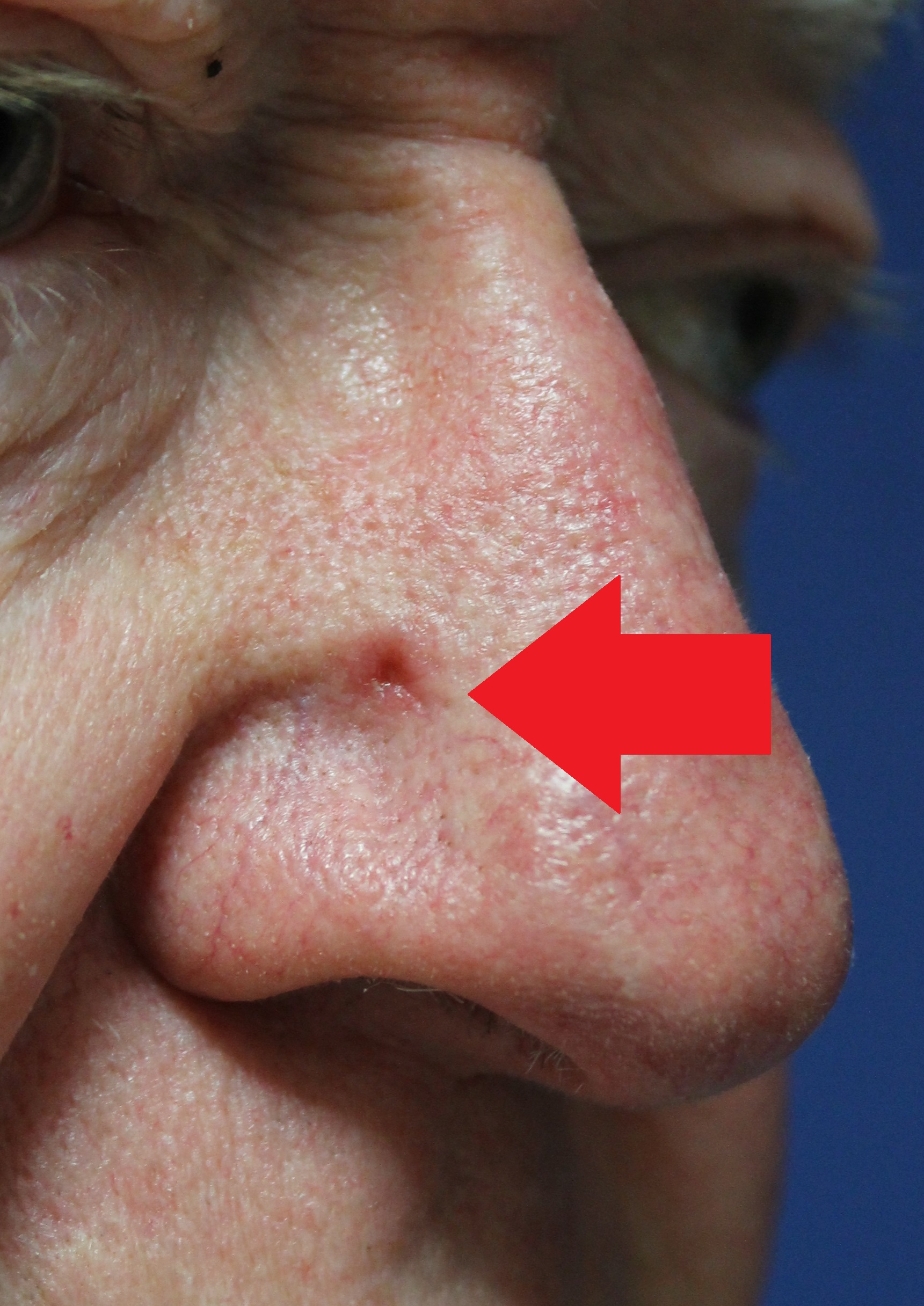 Skin cancer nose