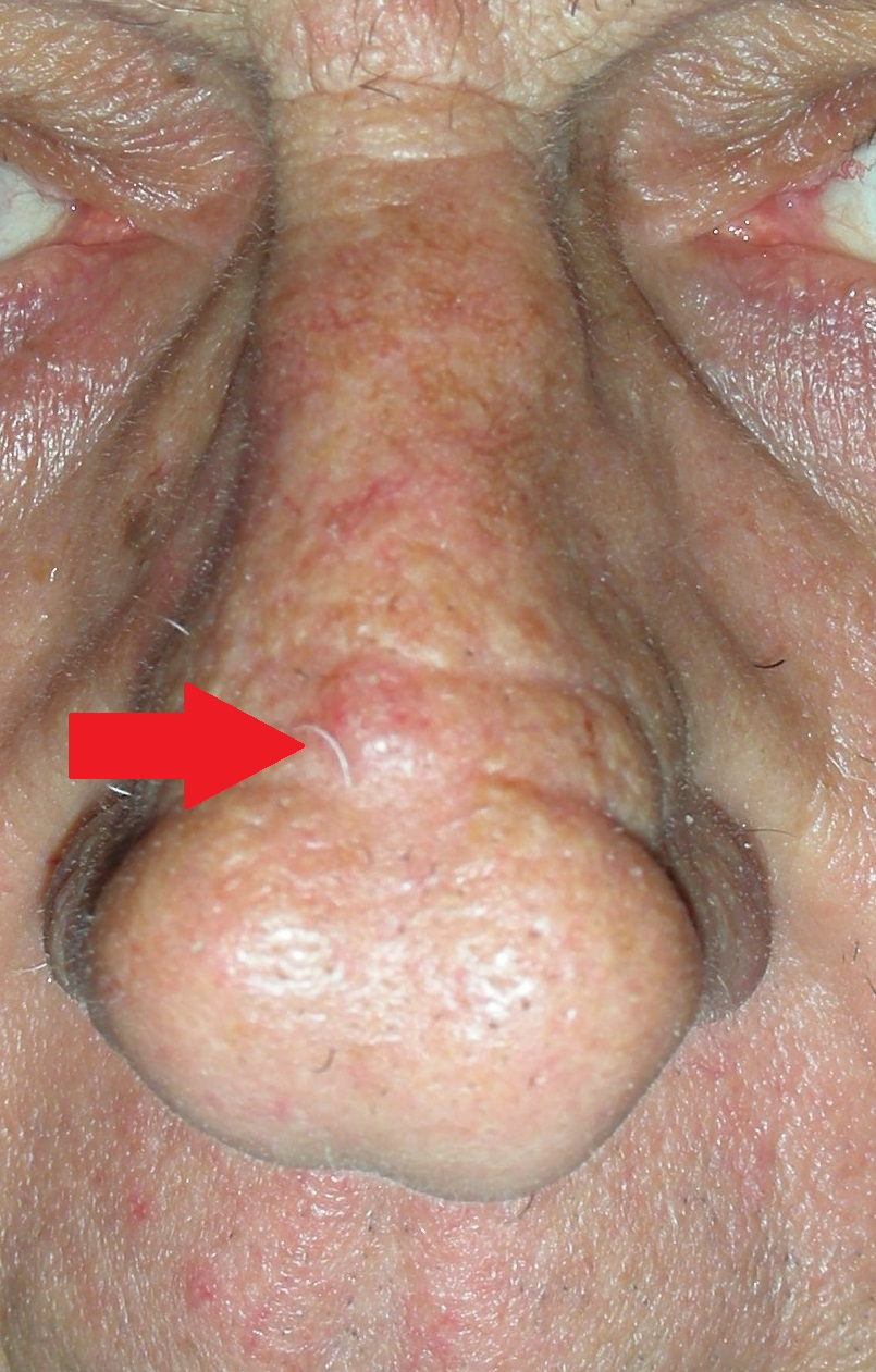 Skin cancer nose