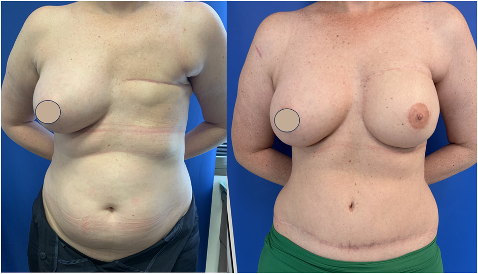 Surgical Compression Garments: DIEP Flap Breast Reconstruction, Revision  Phase
